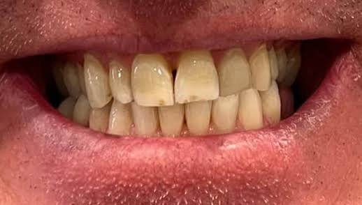Before whitening treatment at Bhati Dental Clinic